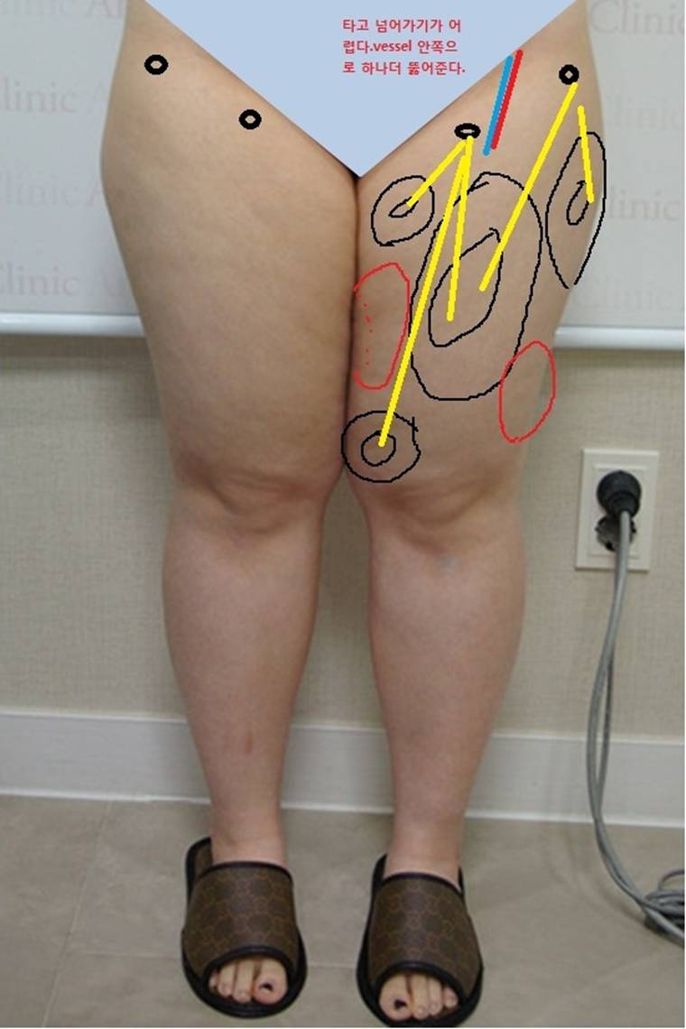 thigh2.jpg